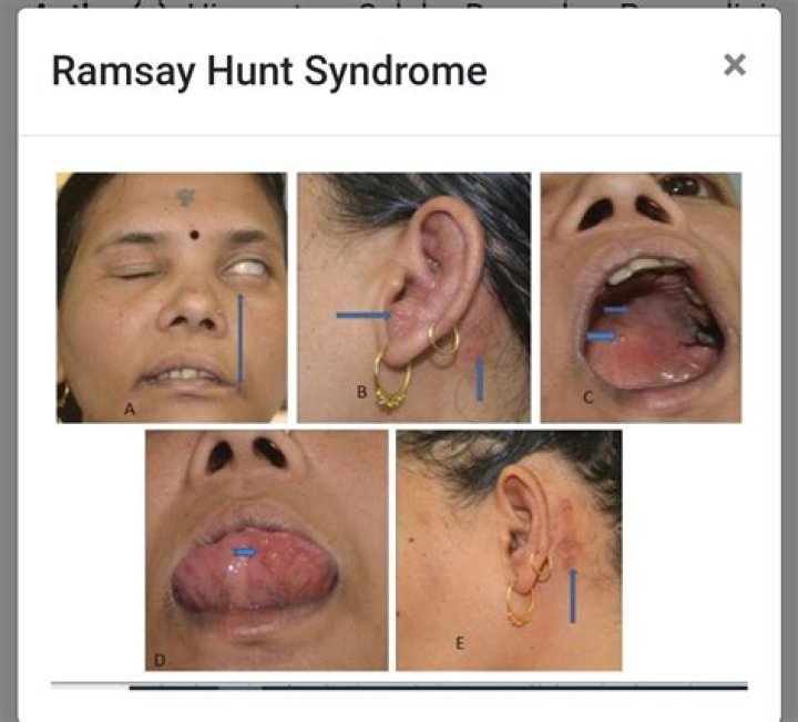 Discover The Hidden Truth About Ramsay Hunt Syndrome